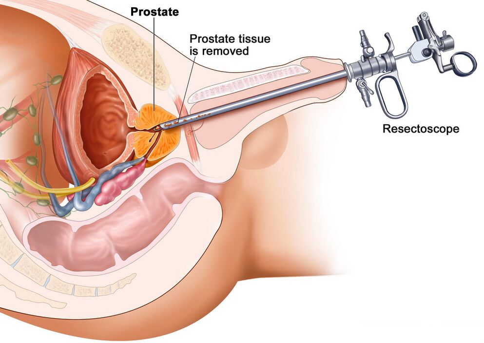 Prostatitin doğru teşhisi için prostat dokusunun toplanması